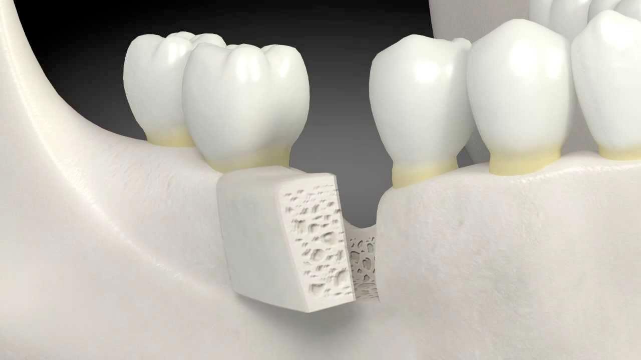 Bone Graft & Sinus Lift